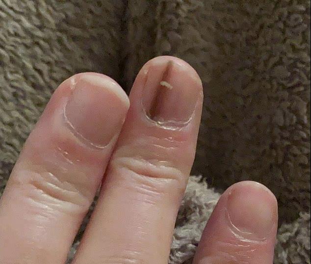 Elizabeta je primetila na noktu belu i crnu mrlju, otišla kod doktora i rekli joj da se udarila: Kad joj nije prošlo, vratila se i nastao je haos