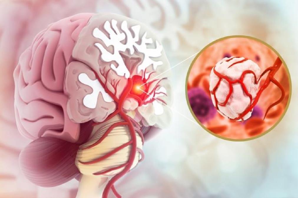 Ovaj jutarnji simptom može biti znak raka mozga: Ako se ponovi više od 2 puta, treba urgentno otići lekaru