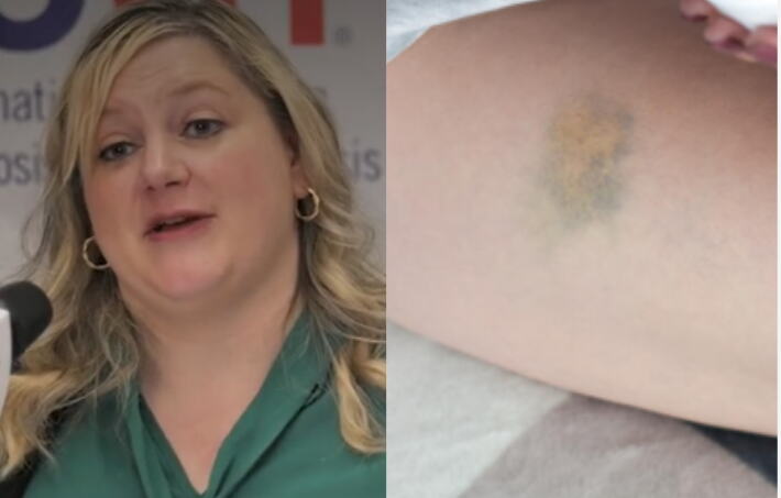 Ukoliko se modrice iz čistog mira stvaraju bez jasnog uzroka, postoji objašnjenje: Hematolog otkriva kada treba ozbiljno da se zabrinete