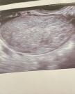 Wasn’t sure about posting this  but here we are  A year ago I had an emergency operation for an ovarian cyst that had exploded in my stomach. 3 months after, my belly started to hurt again and  at the  (4).jpg