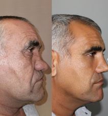 naser estetska operacija.png