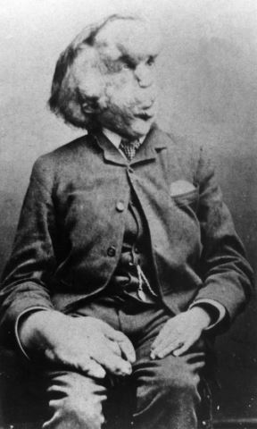 joseph-merrick-carte-de-visite-photo-c.-1889.jpg