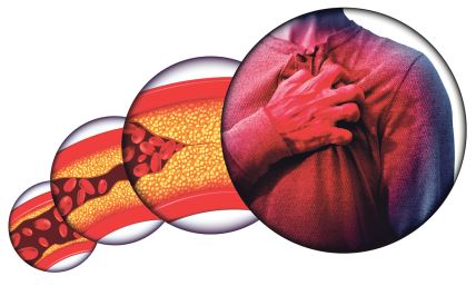 GLAVNA stock-photo-human-heart-disease-and-chest-pain-from-clogged-arteries-and-artery-damaged-with-cholesterol-1367408030.jpg