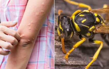 alergijska reakcija ujeda stršljena