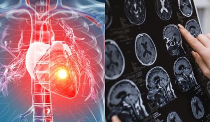 moždani i srčani udar.jpg