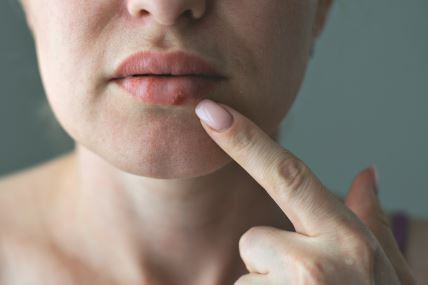 GLAVNA  stock-photo-the-woman-with-a-virus-herpes-on-lips-2356075565.jpg