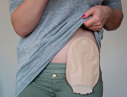 GLAVNA  stock-photo-front-view-on-colostomy-pouch-in-skin-color-attached-to-young-woman-patient-close-up-on-ostomy-bag-1317547595.jpg