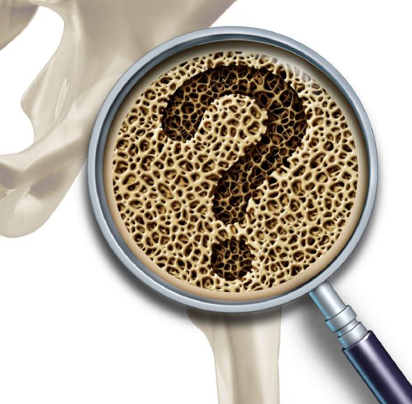 osteoporoza-shutterstock-285181010.jpg