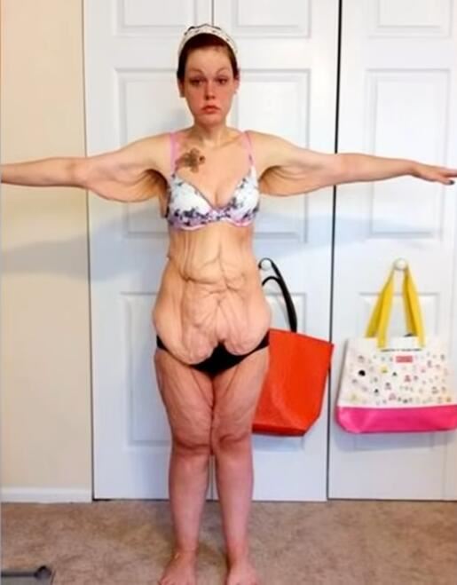 tlc-uk--mother-loses-339-lb-to-make-her-child-proud-my-extreme-excess-skin-r2evtxb5bse--1180x664--9m00s.jpg