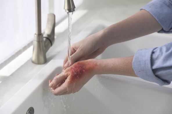 opekotina--stockphotowomanholdinghandwithburnunderflowingwaterindoorscloseup2237125313.jpg