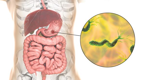 stockphotostomachulcerandcloseupviewofbacteriahelicobacterpyloriassociatedwithulcerformationd1928575139.jpg