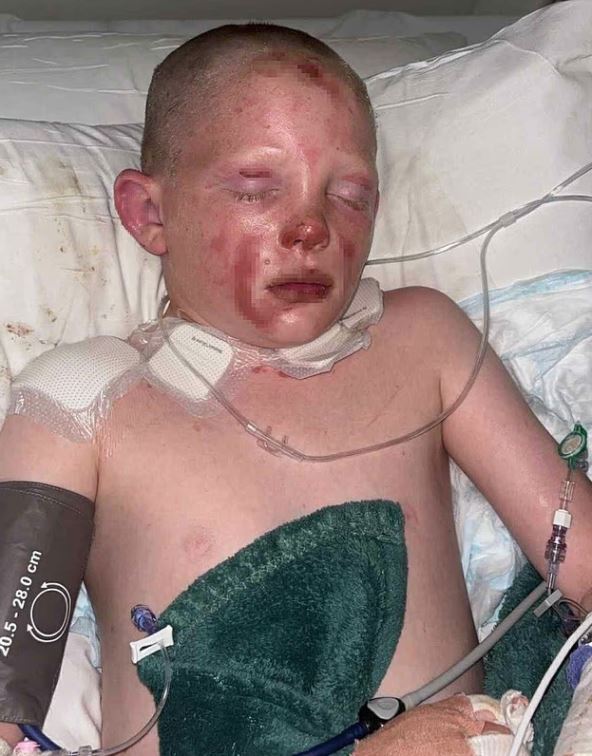 Dečak koji se zapalio