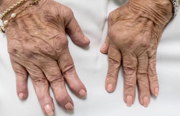 Reumatoidni artritis