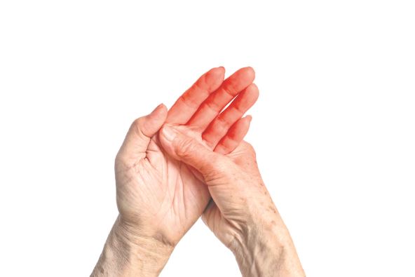 REUMATSKI BOLOVI  stock-photo-hand-joints-inflammation-concept-and-idea-of-rheumatic-arthritis-rheumatism-gout-joint-swelling-2254582189.jpg