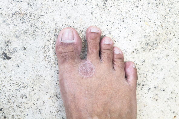 GLJIVICE I BRADAVICE   stock-photo-foot-fungus-407791324.jpg