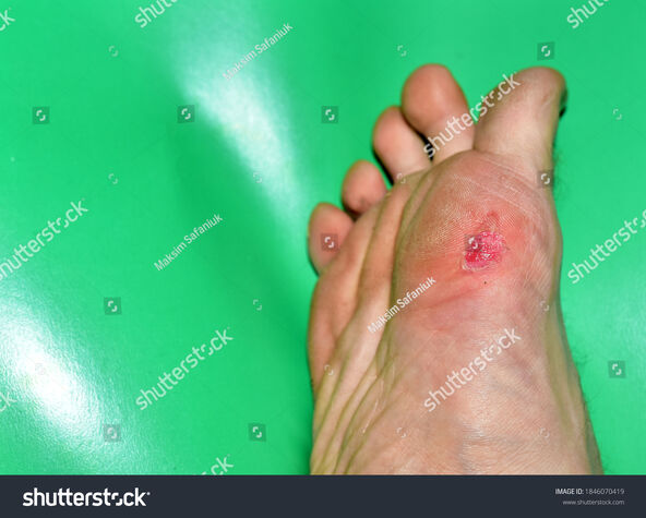 GLOSA   stock-photo-callus-on-the-foot-on-a-male-foot-human-leg-with-a-wound-corns-and-calluse-skin-dermatology-1846070419.jpg