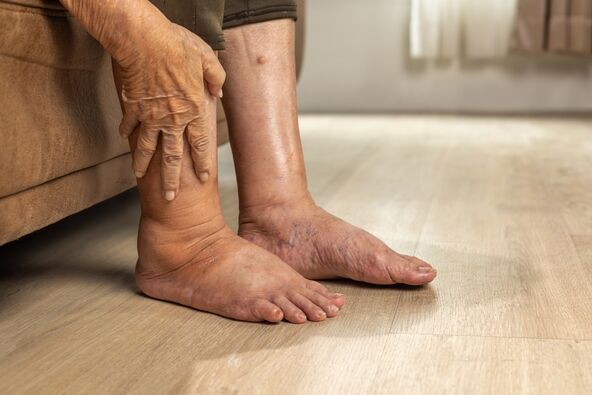 Otok stopala