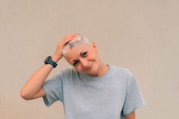 PRIPREMITE SE NA MOGUC GUBITAK KOSE  stock-photo-real-alopecia-areata-in-a-young-girl-a-bald-head-in-a-person-diffuse-alopecia-androgenic-2373219363.jpg