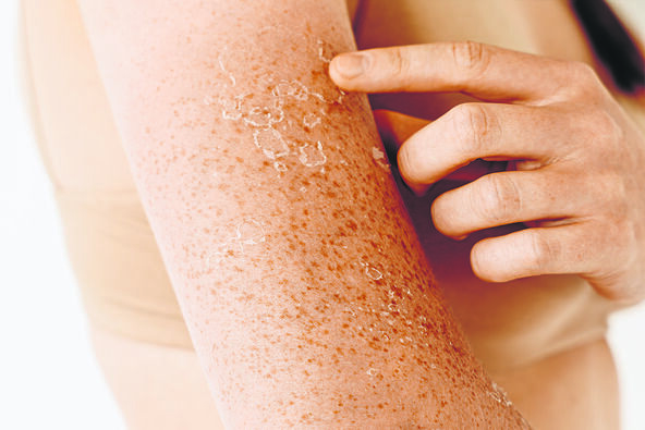 stock-photo-peeling-skin-with-freckles-after-sunburn-dermatological-problems-on-female-arms-and-shoulders-2355423831.jpg