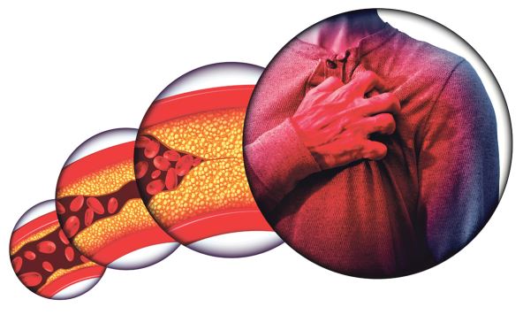 GLAVNA stock-photo-human-heart-disease-and-chest-pain-from-clogged-arteries-and-artery-damaged-with-cholesterol-1367408030.jpg